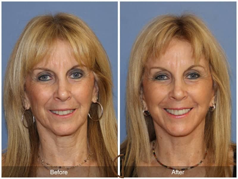 Facelift Newport Beach 180 Image
