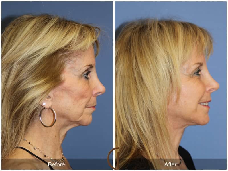 Facelift Newport Beach 180 Image