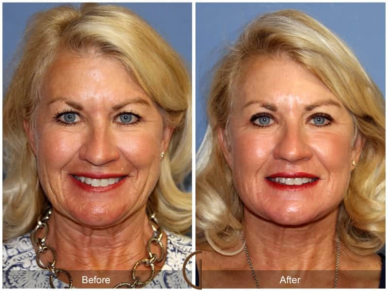 Facelift Newport Beach 184 Image