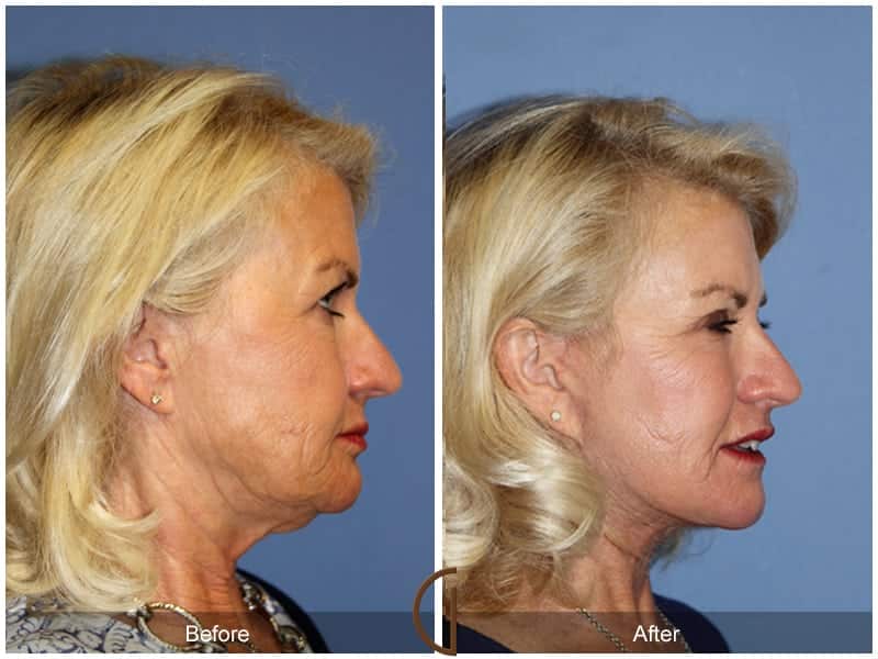 Facelift Newport Beach 184 Image