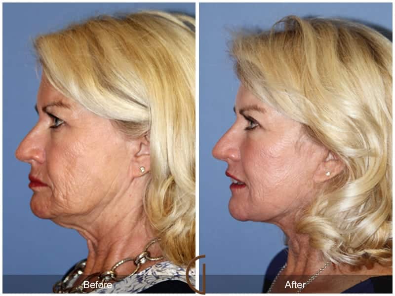 Facelift Newport Beach 184 Image