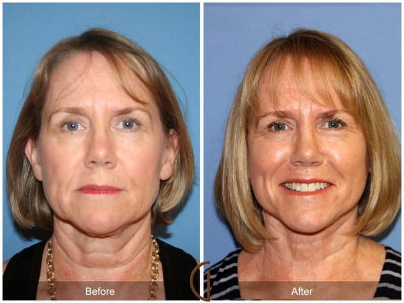 Facelift Newport Beach 183 Image