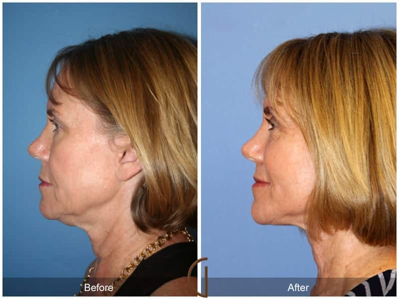 Facelift Newport Beach 183 Image