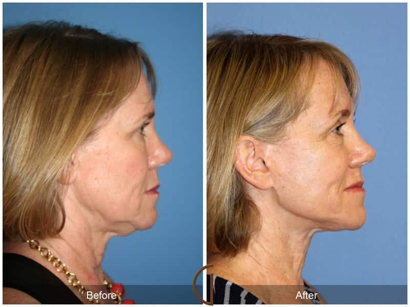 Facelift Newport Beach 183 Image