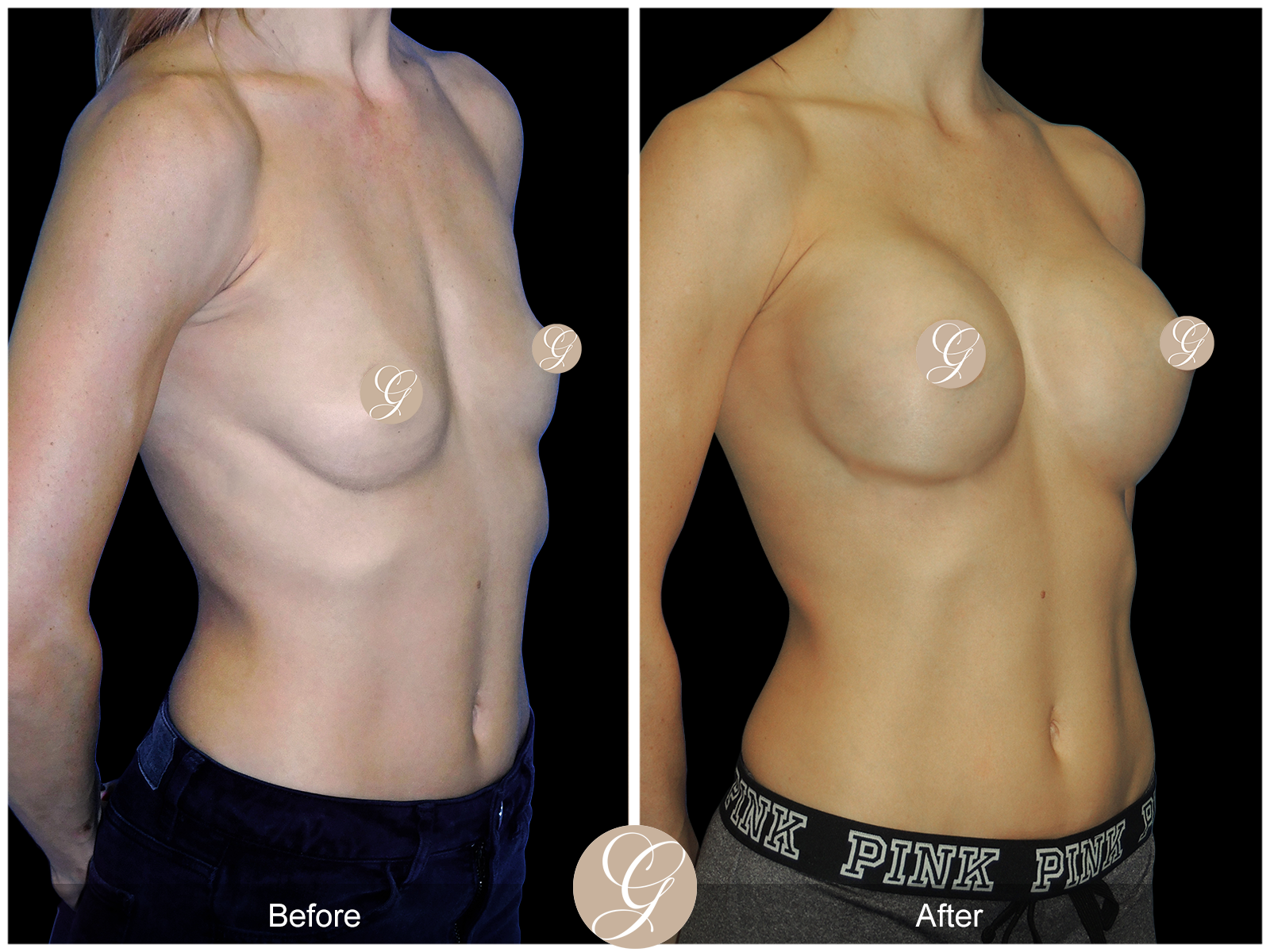 Breast Augmentation PT5 Image