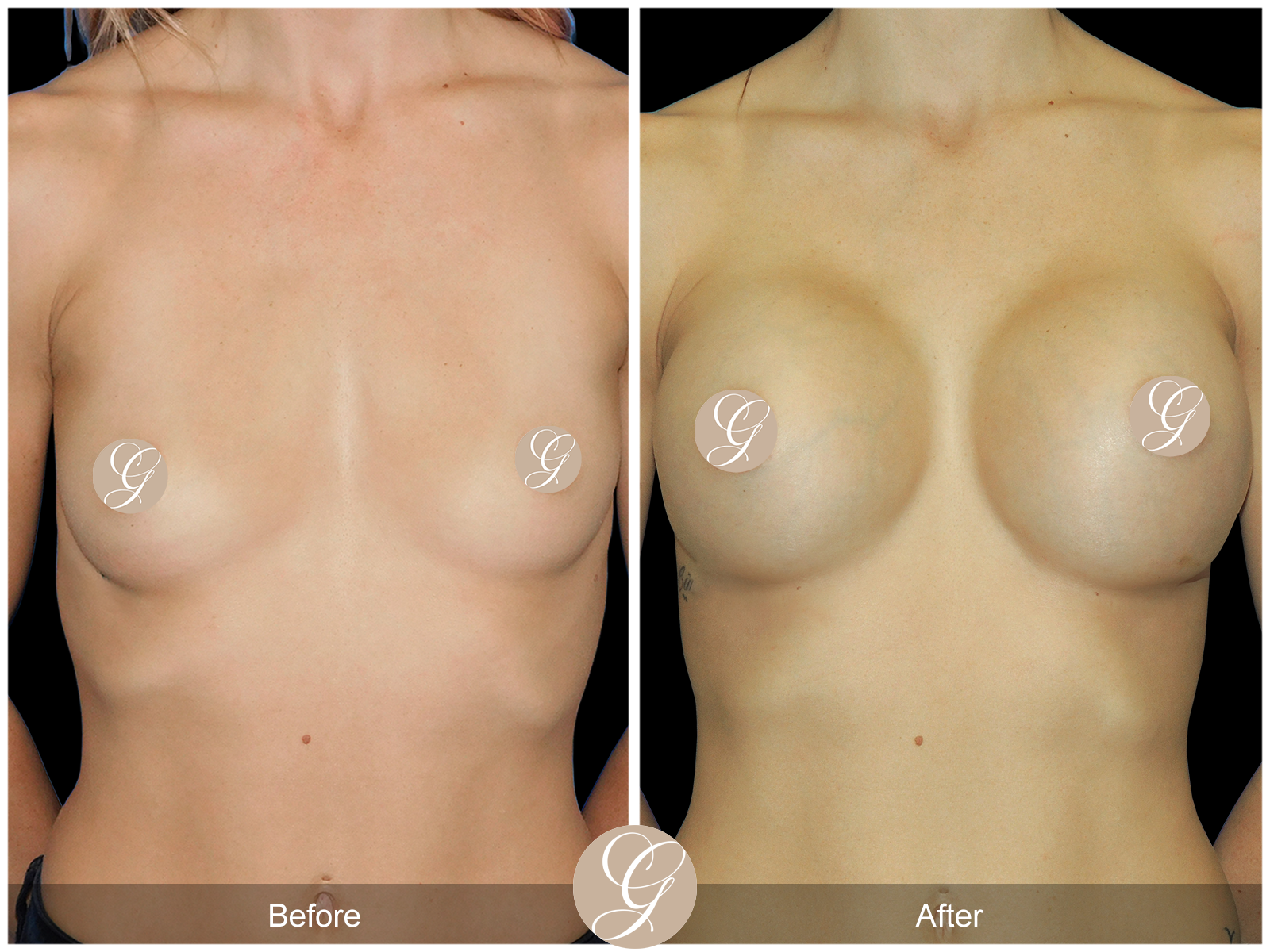 Breast Augmentation PT5 Image
