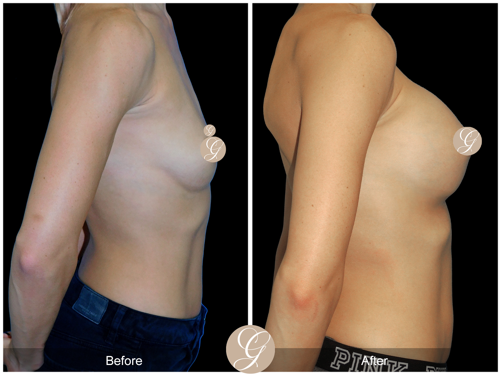 Breast Augmentation PT5 Image