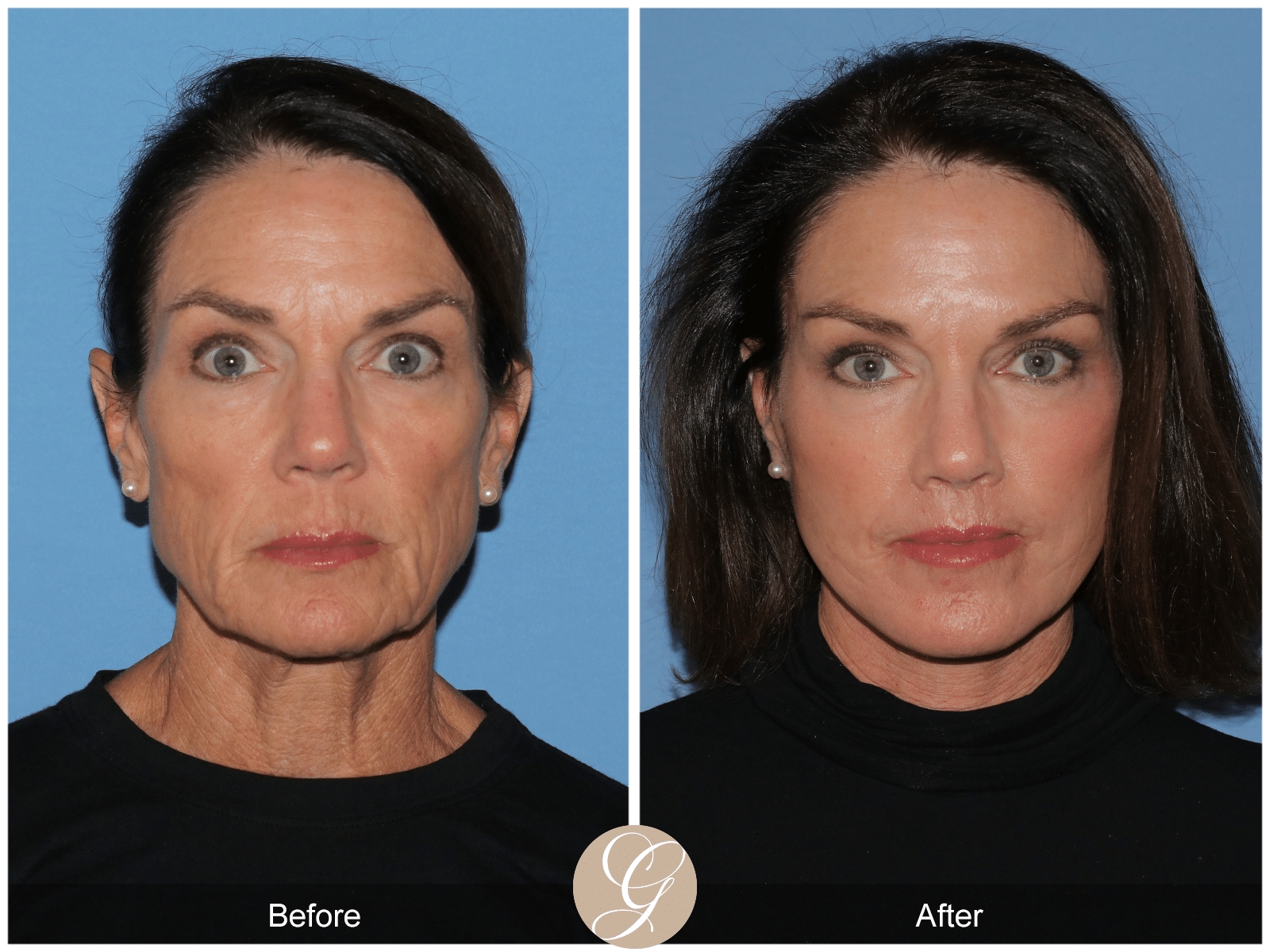 <strong>Top Myths About Deep Plane Facelift</strong> Image
