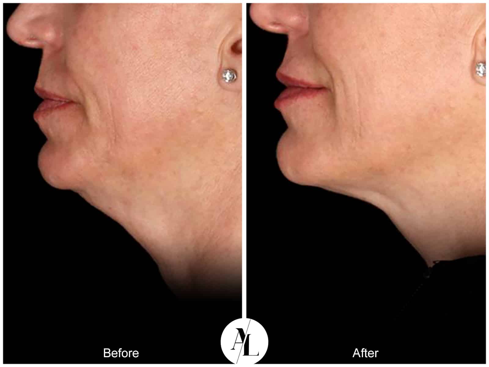 PROFOUND SKIN TIGHTENING- 8 Image