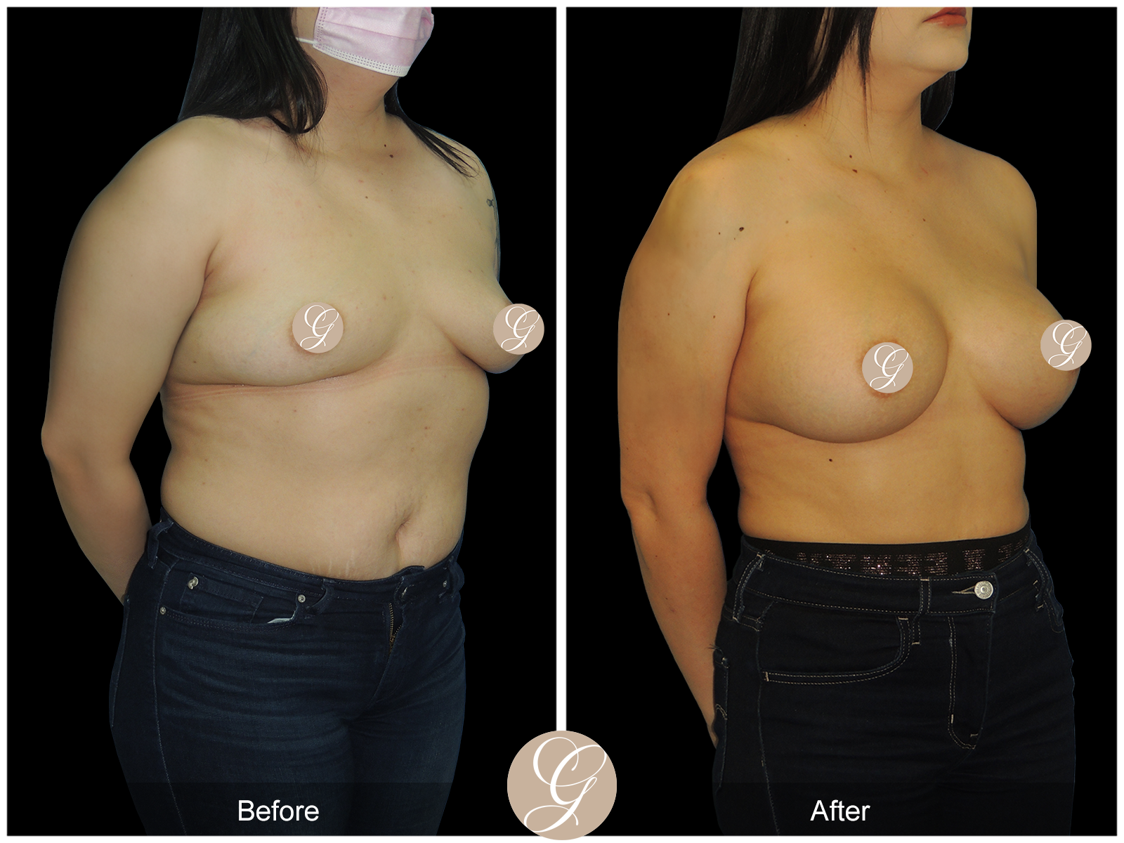 Breast Augmentation with Fat Grafting PT1 Image