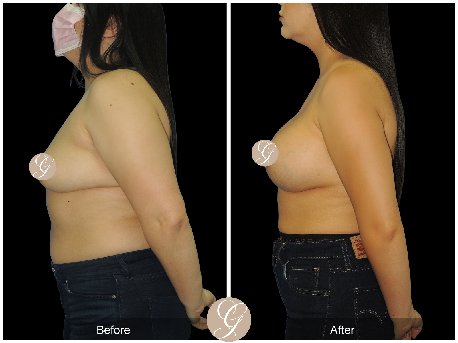 Breast Augmentation with Fat Grafting PT1 Image