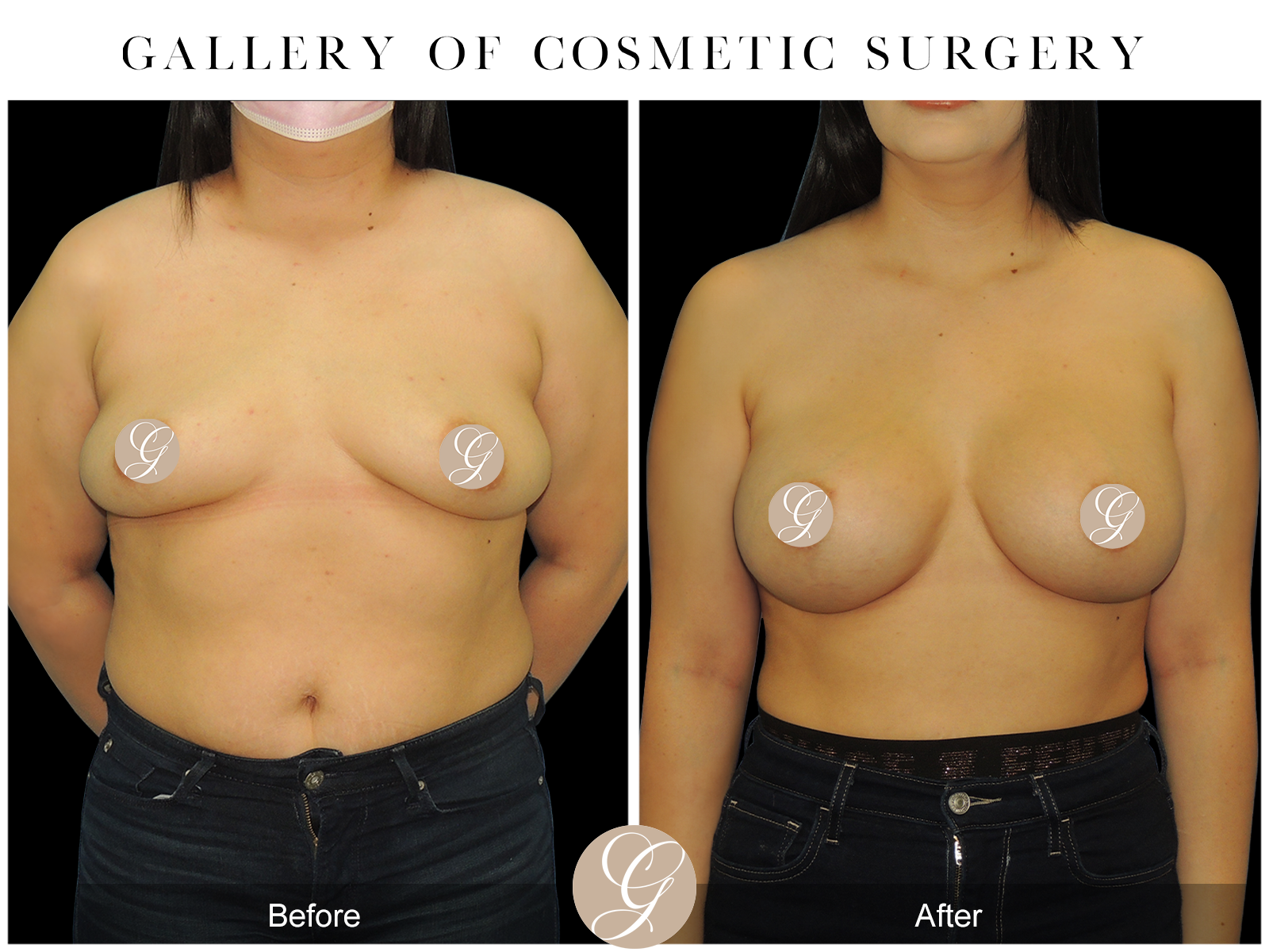 Breast Augmentation with Fat Grafting PT1 Image
