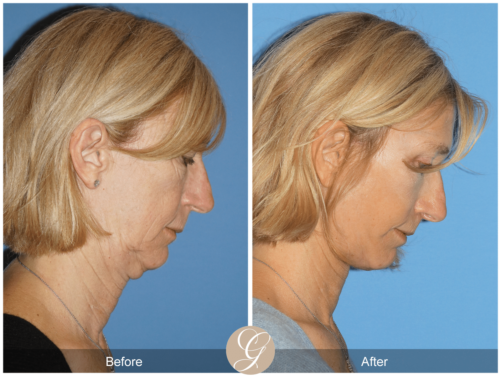 Deep Plane Facelift Case 6 Image