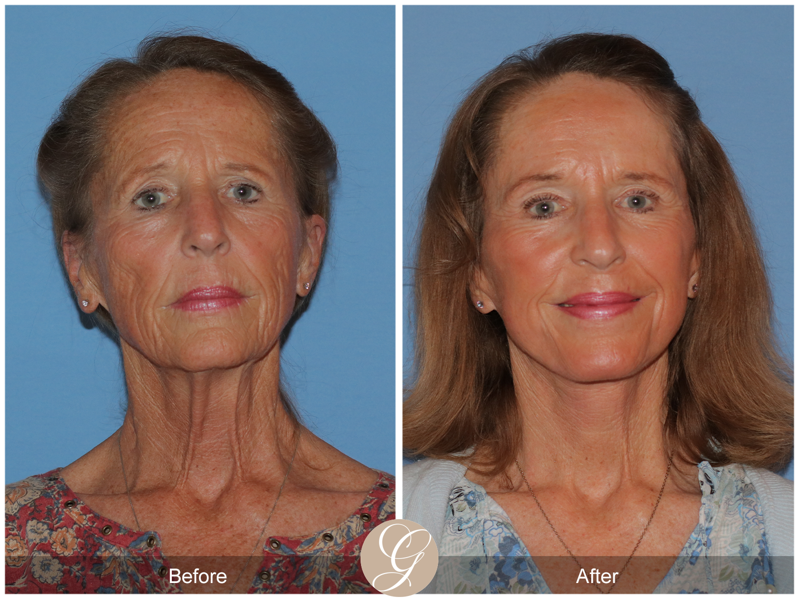 Preservation Facelift Case 11 Image