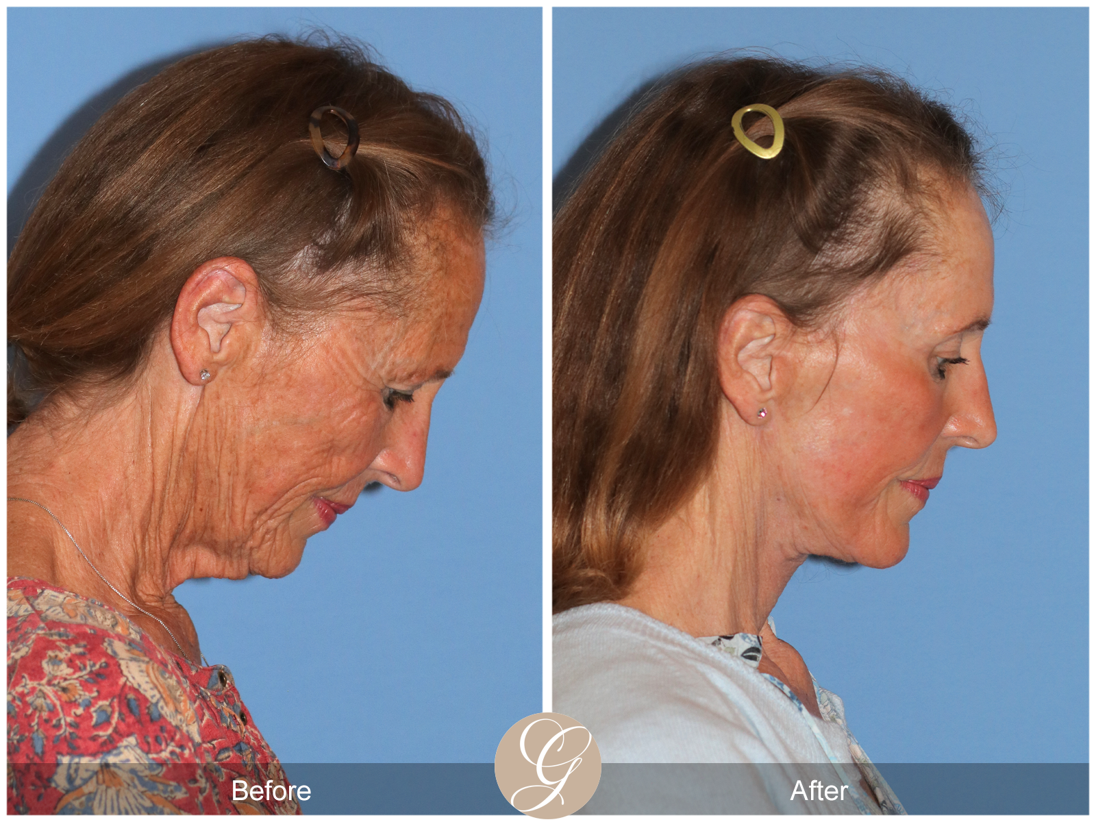 Preservation Facelift Case 11 Image