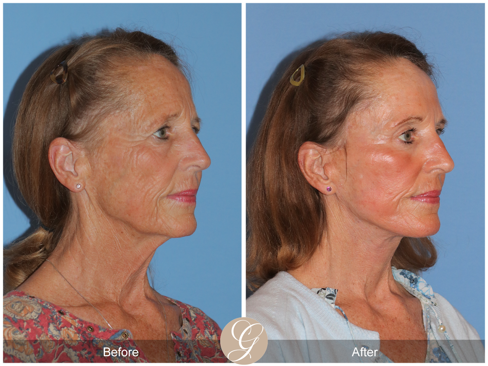 Preservation Facelift Case 11 Image