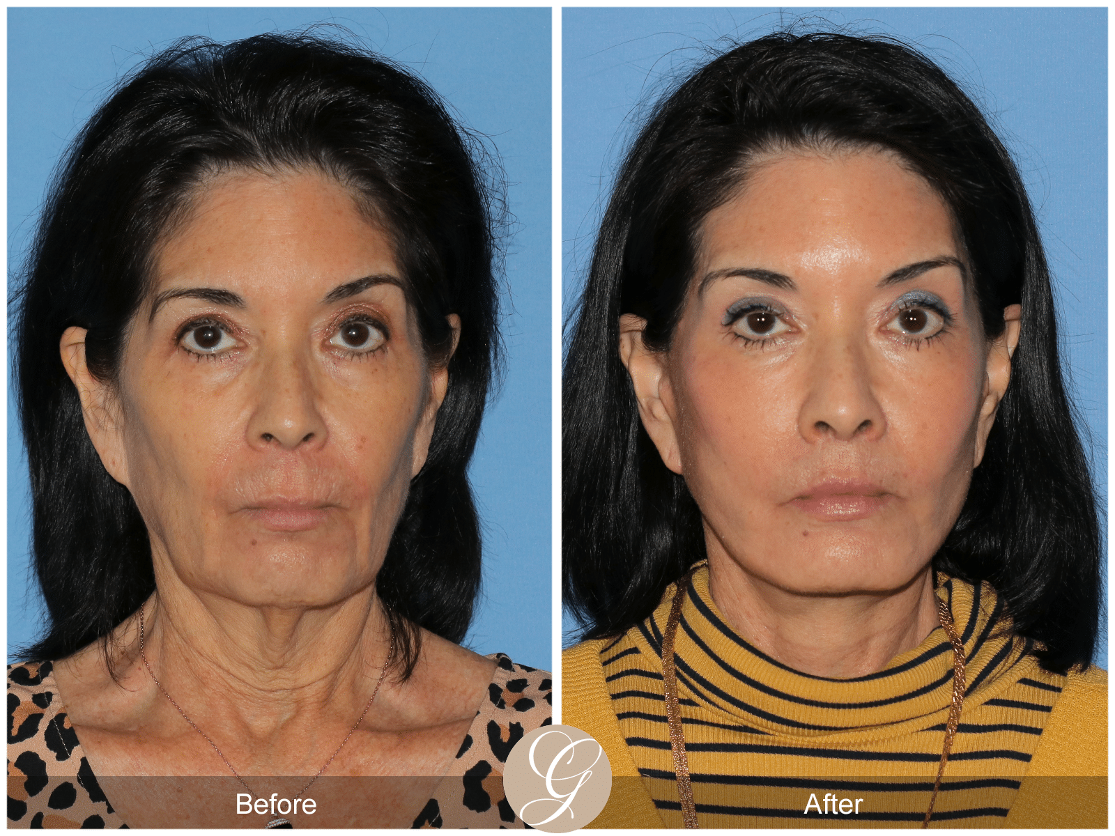 Deep Plane Facelift Case 9