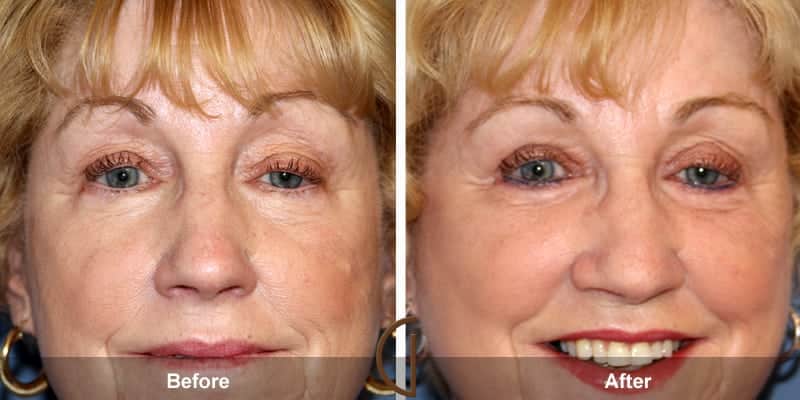 Eyelid Surgery Newport Beach 62 Image