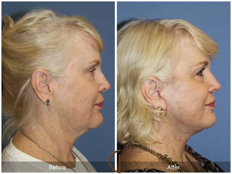 Facelift Newport Beach 187 Image