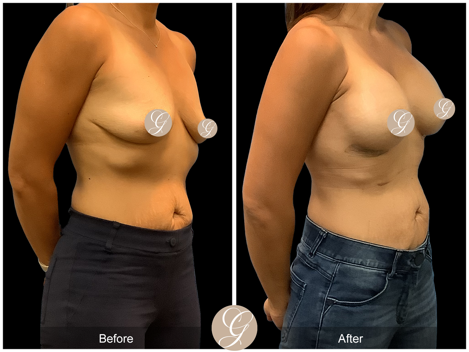 Breast Augmentation PT10 Image