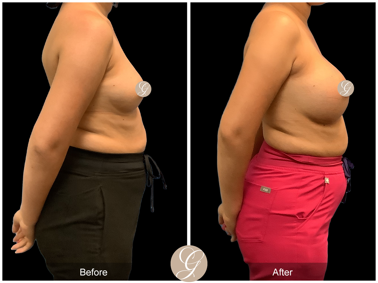 Breast Augmentation PT16 Image