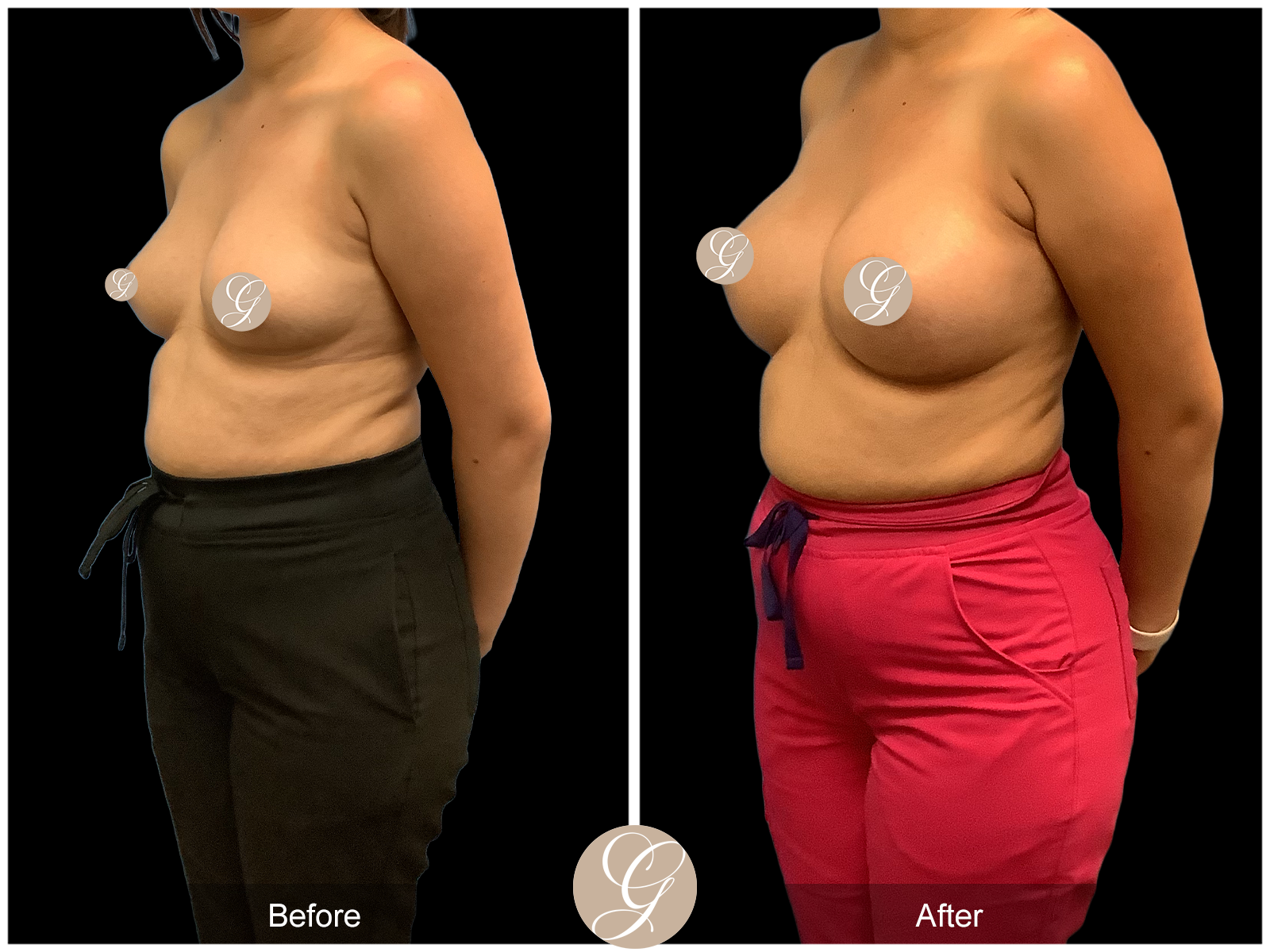 Breast Augmentation PT16 Image