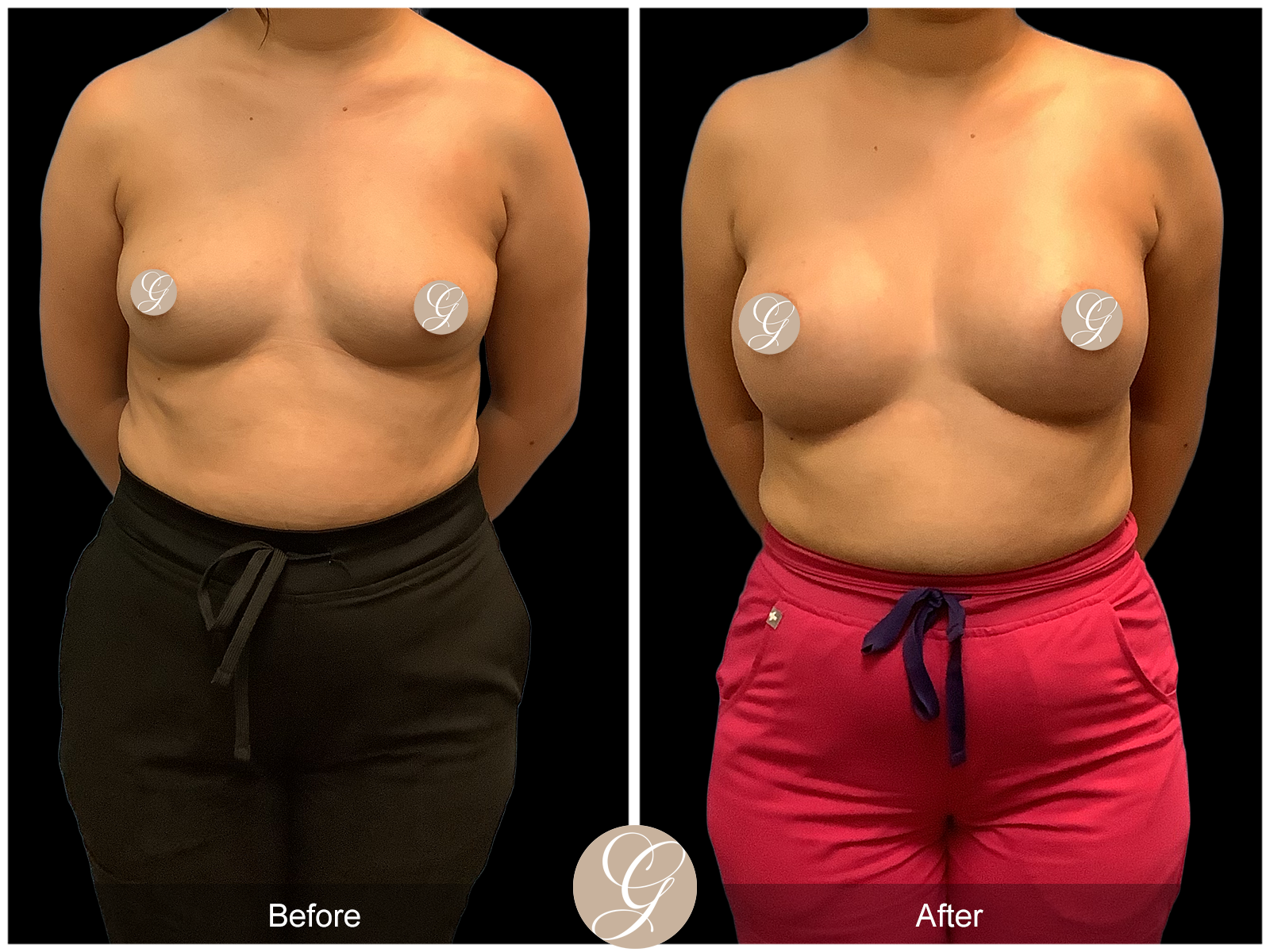 Breast Augmentation PT16 Image