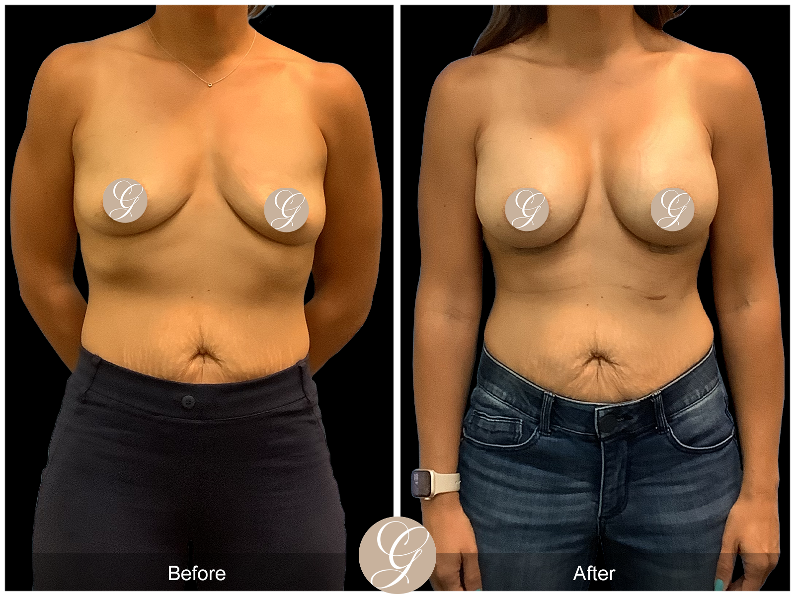 Breast Augmentation PT10 Image