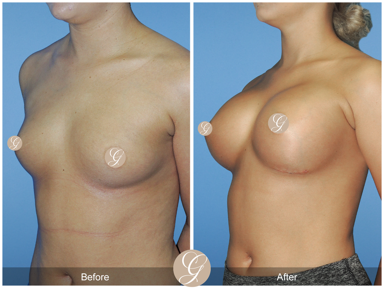 Breast Augmentation PT4 Image