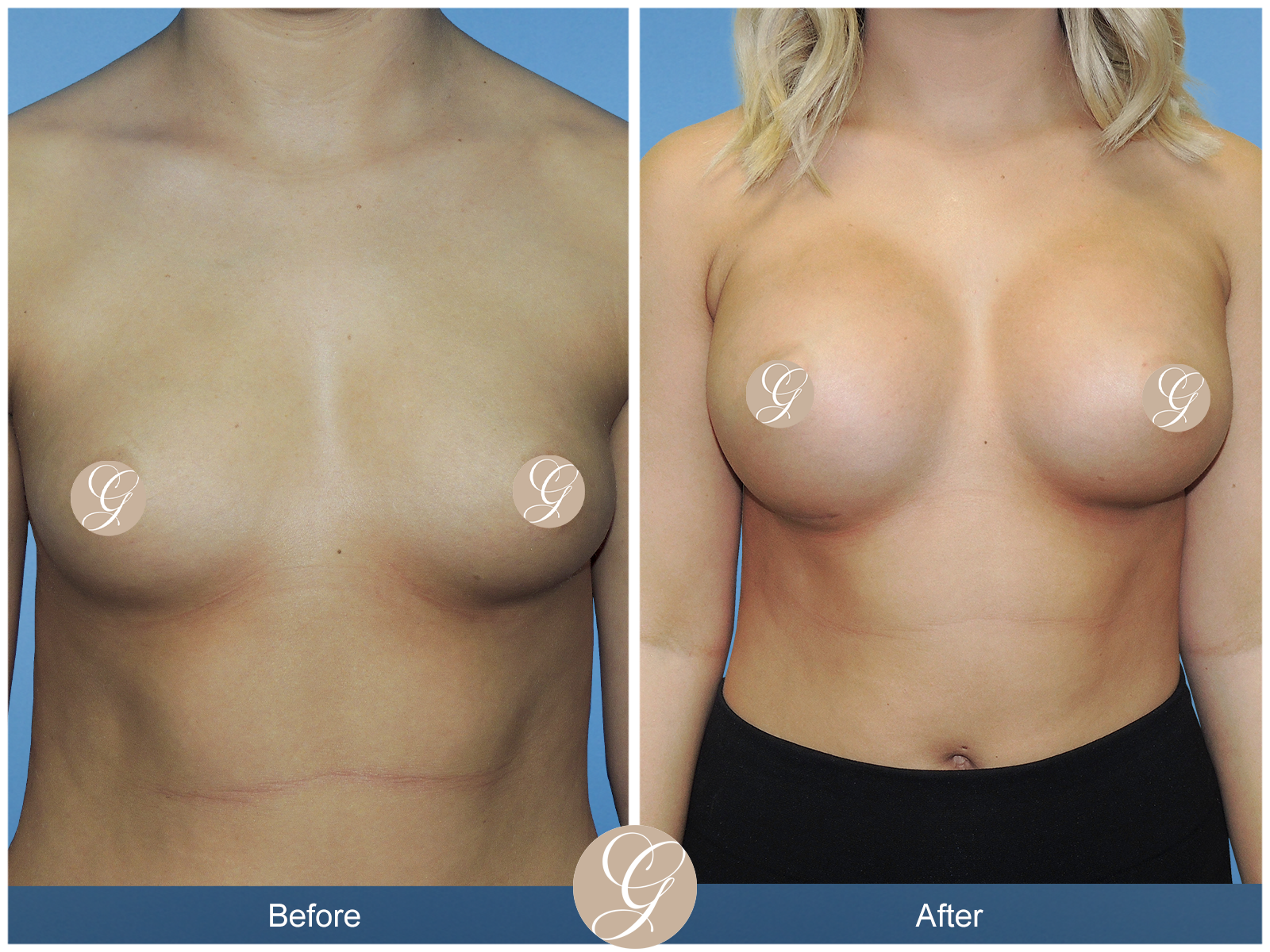 Breast Augmentation PT4 Image