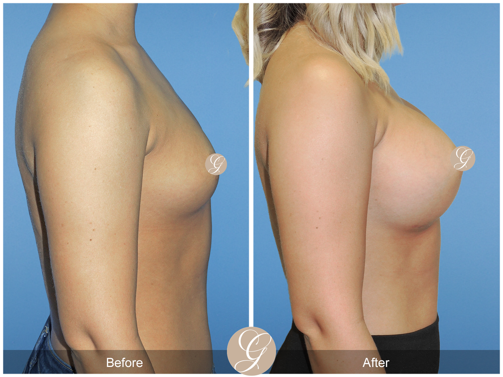 Breast Augmentation PT4 Image