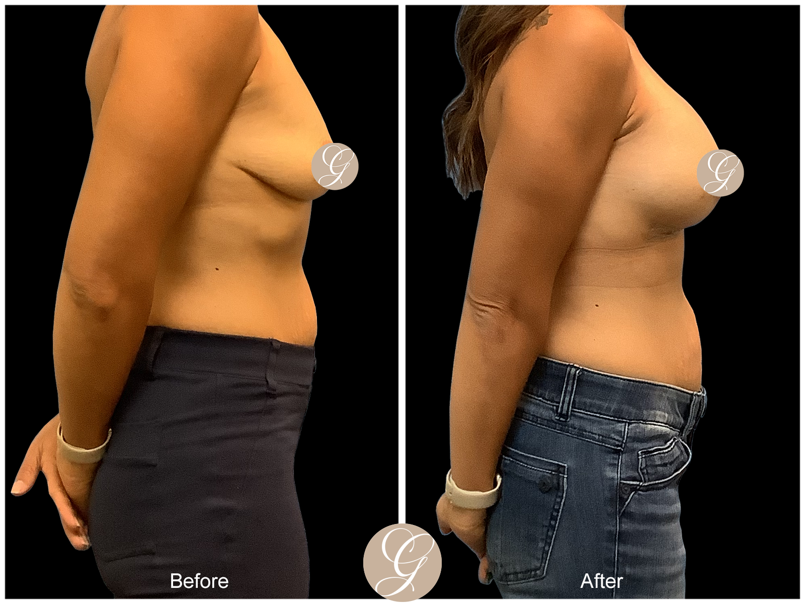 Breast Augmentation PT10 Image