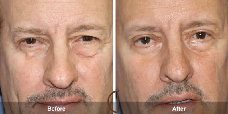 Eyelid Surgery Orange County 44 Image