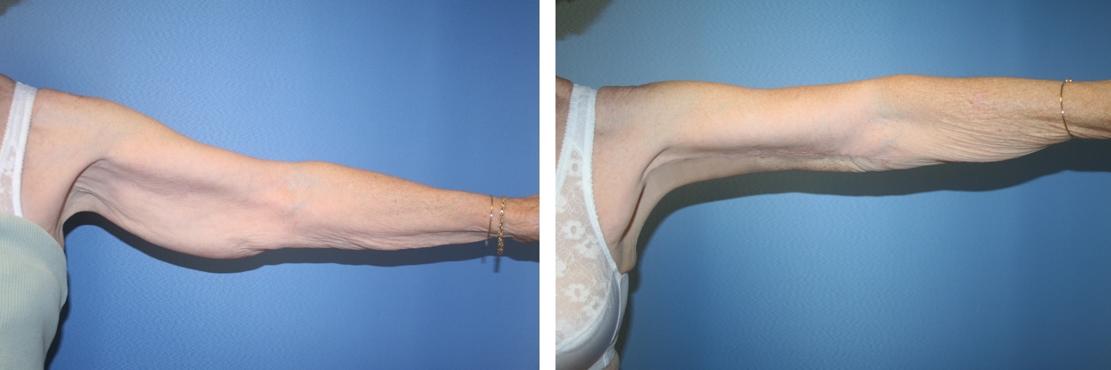Arm Lift can help you fit into your new clothes this new year Image