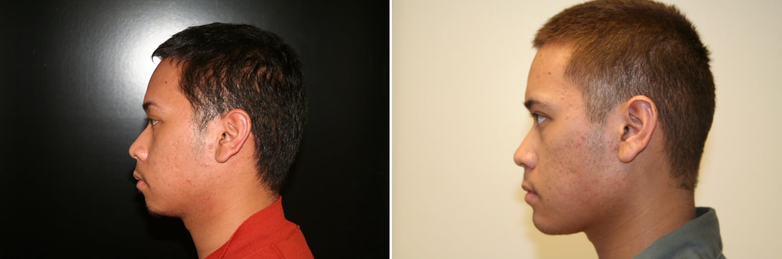 Chin Augmentation Orange County CA 1 Image