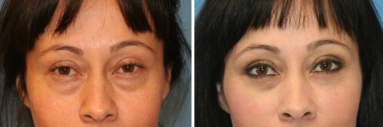 Eyelid Surgery Orange County CA 1 Image