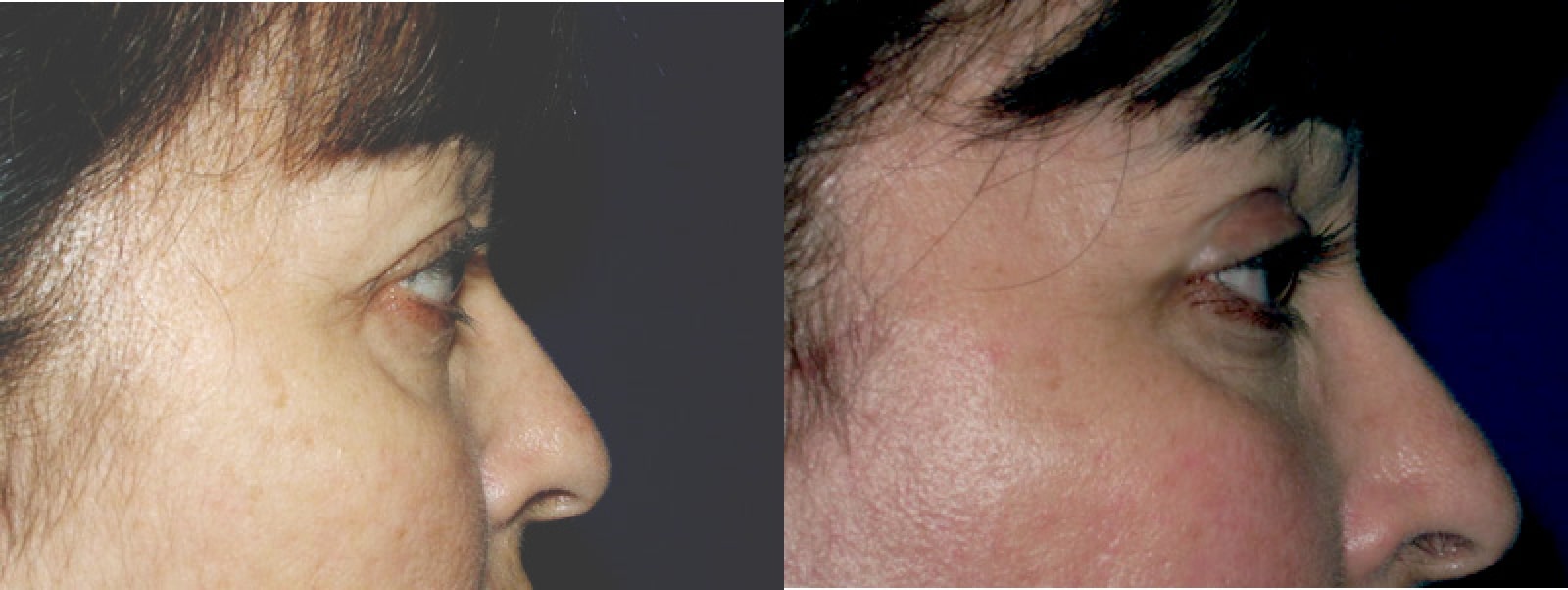 Eyelid Surgery Orange County CA 10 Image