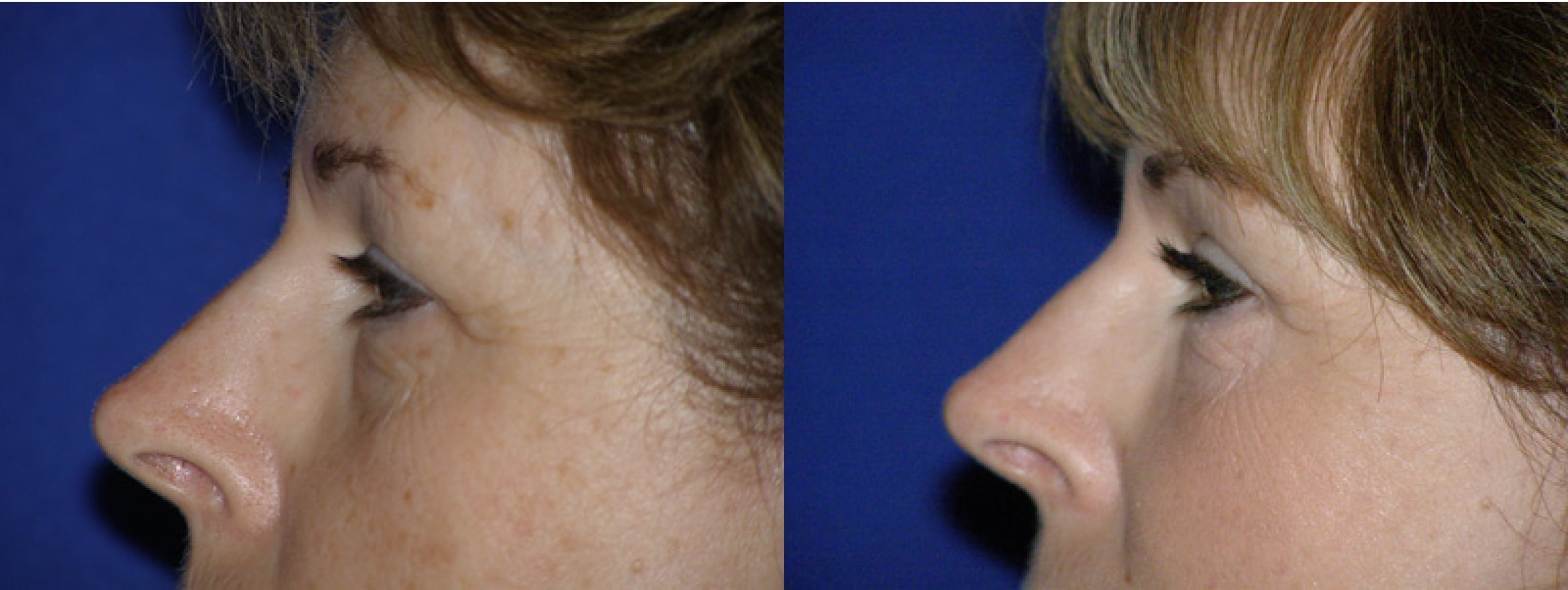 Eyelid Surgery Villa Park CA 11 Image