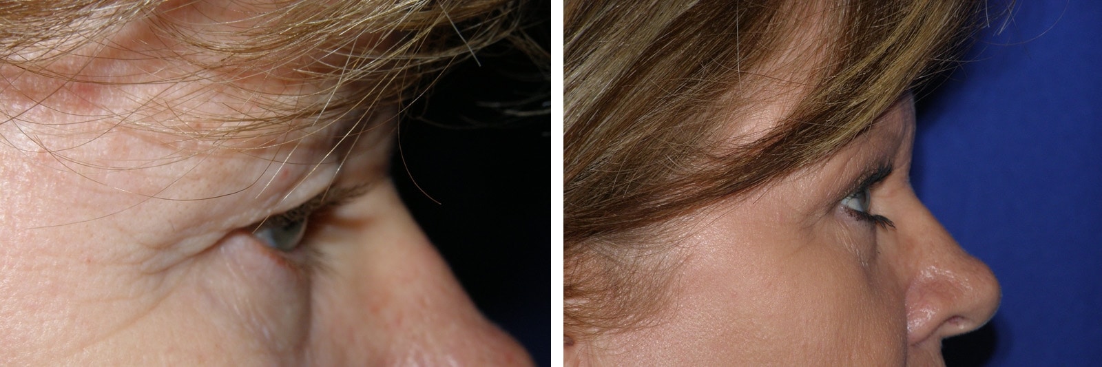 Eyelid Surgery Mission Viejo CA 3 Image