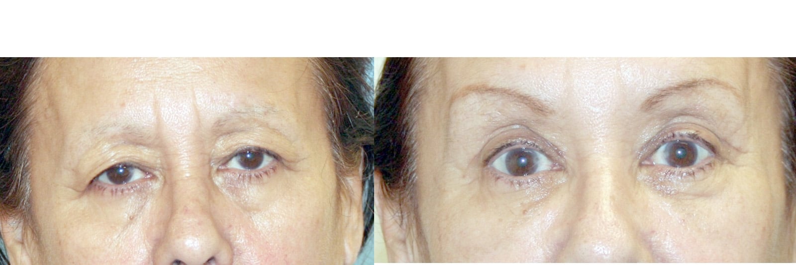 Eyelid Surgery Laguna Beach CA 4 Image