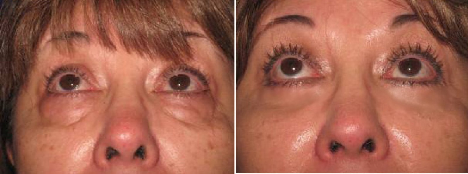 Eyelid Surgery Orange County CA 5 Image