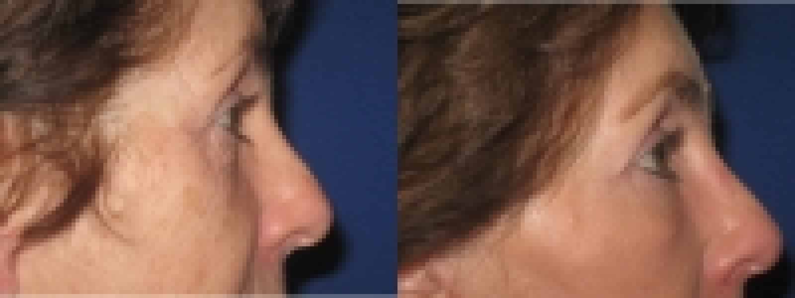 Eyelid Surgery Irvine CA 6 Image