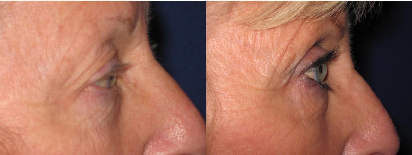 Eyelid Surgery Orange County CA 7 Image
