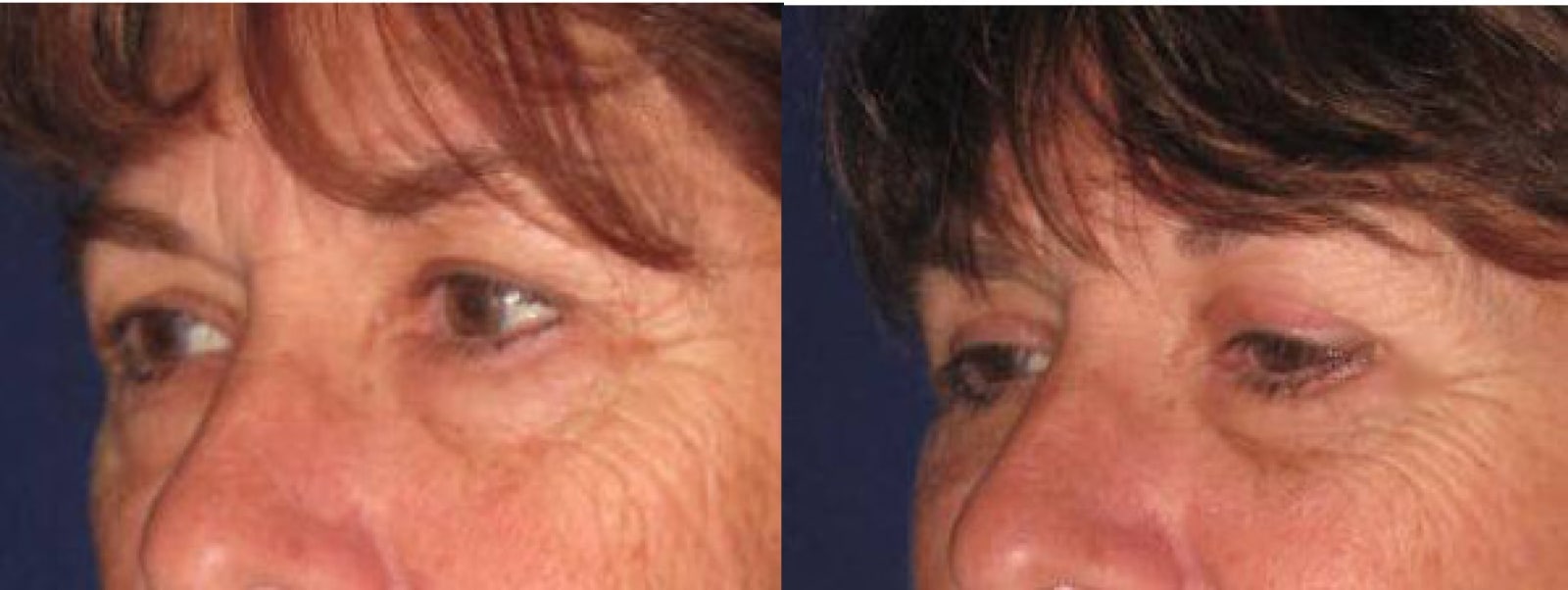 Eyelid Surgery Orange County CA 8 Image