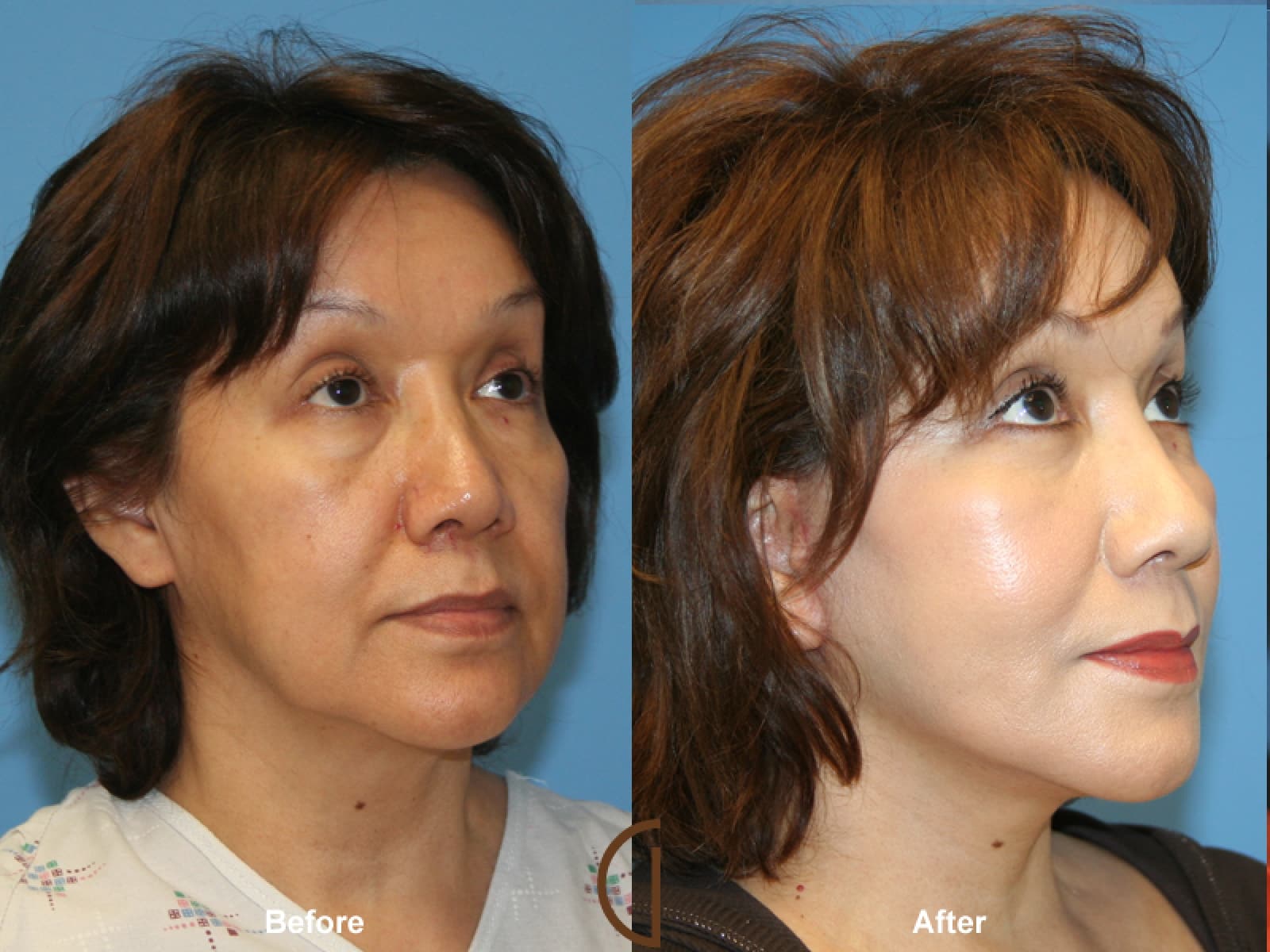 Facelift Mission Viejo CA 11 Image