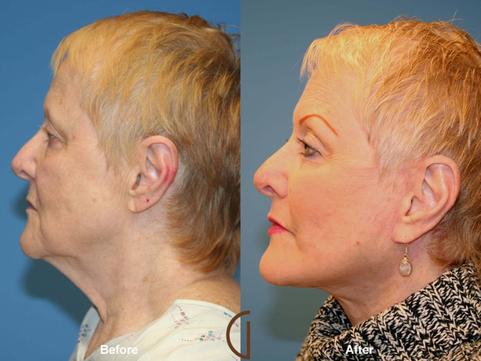 Facelift Coronado CA 2 Image