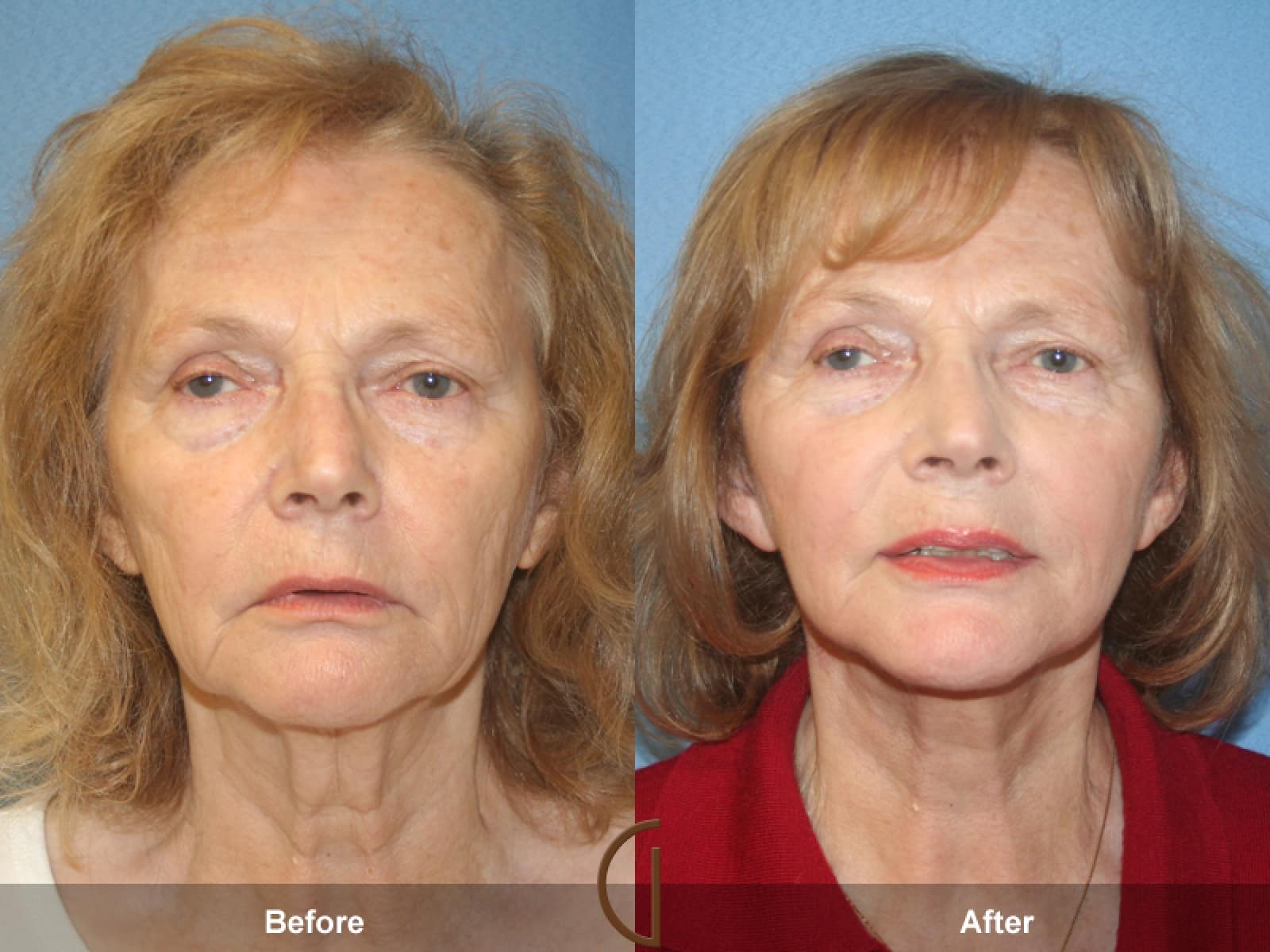 Facelift La Crescenta-Montrose CA 23 Image