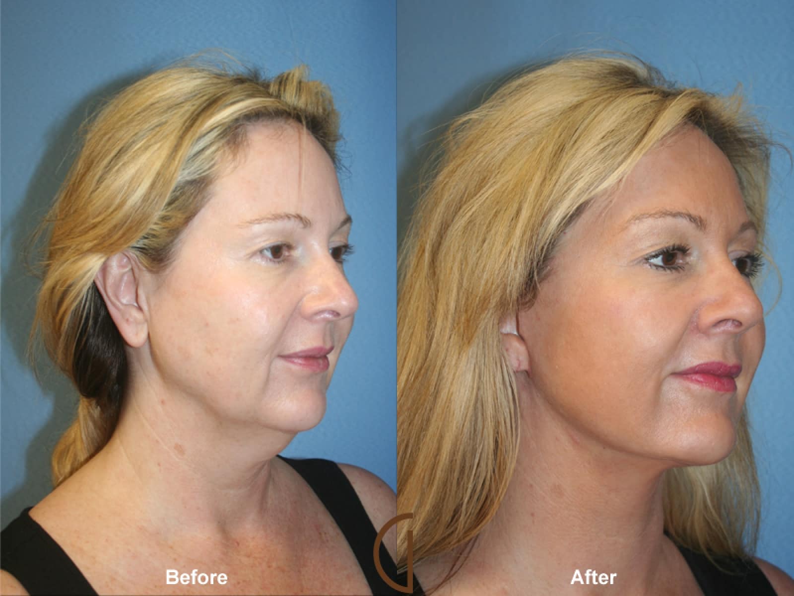 Facelift Carlsbad CA 32 Image