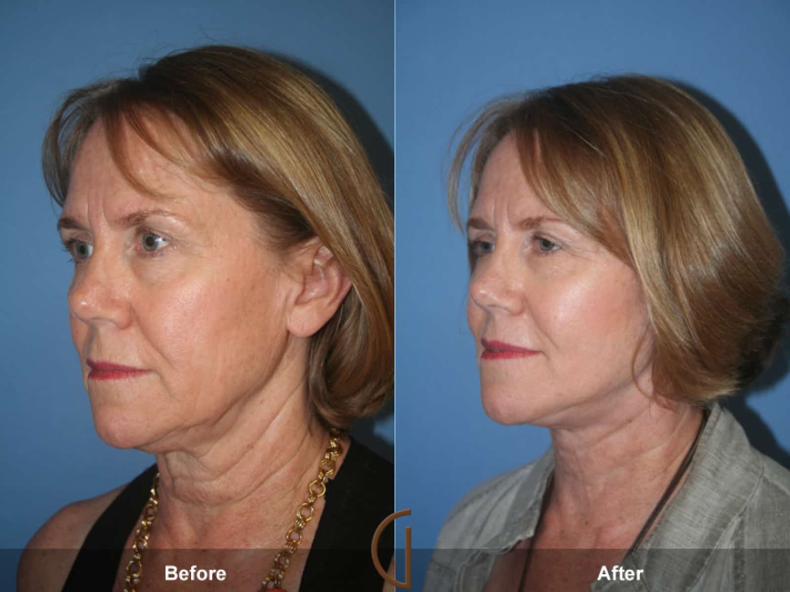 Facelift Warm Springs CA 51 Image