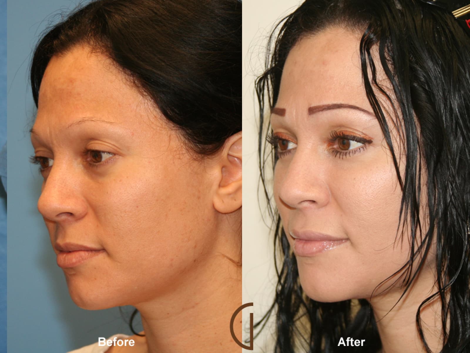 Facial Fat Grafting Orange County CA 1 Image